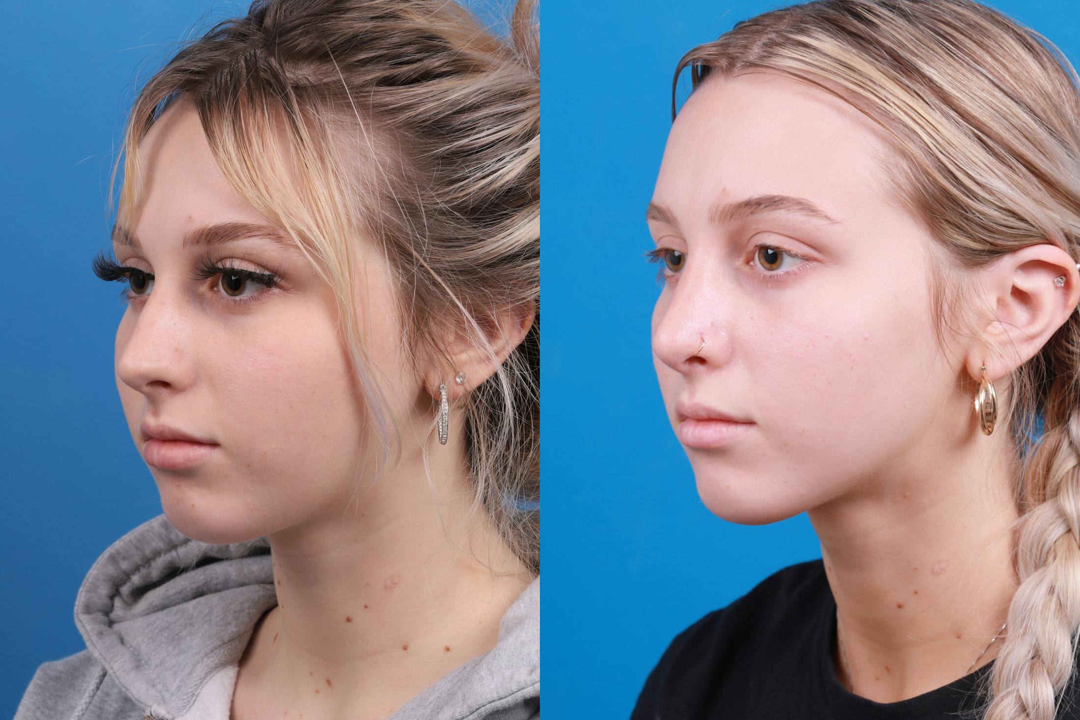 Rhinoplasty Before & After Gallery - Patient 148430547 - Image 3