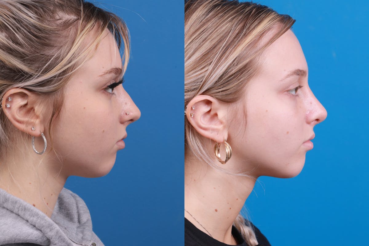 Rhinoplasty Before & After Gallery - Patient 148430547 - Image 4