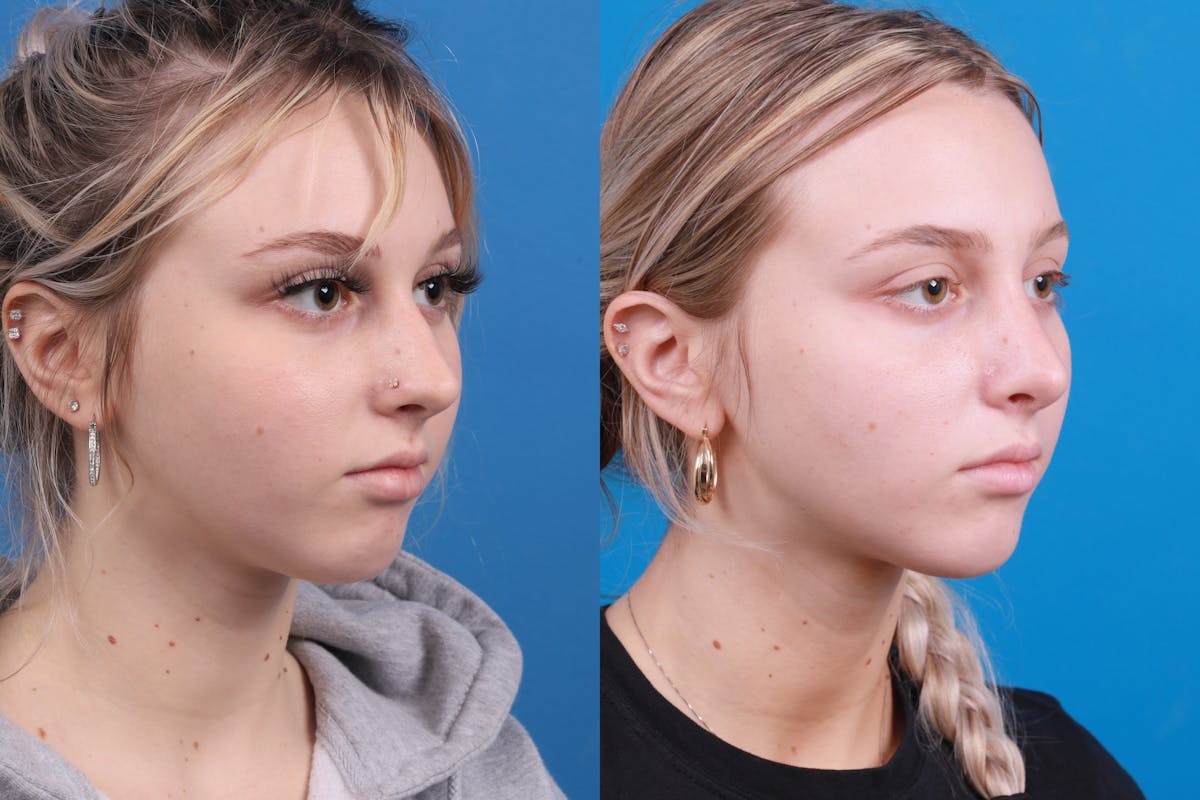 Rhinoplasty Before & After Gallery - Patient 148430547 - Image 5