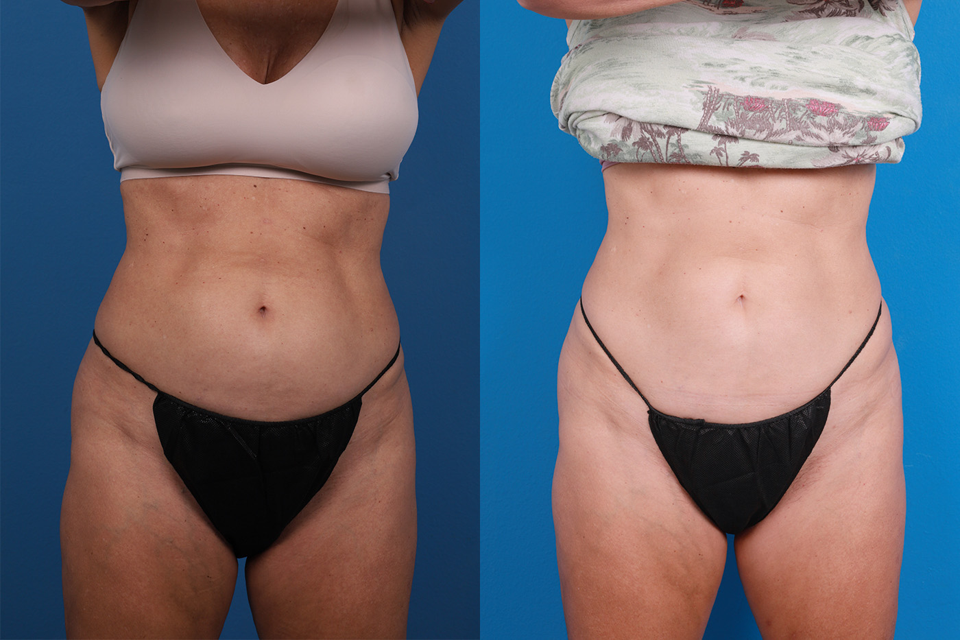 CoolSculpting Before & After Gallery - Patient 816350 - Image 1