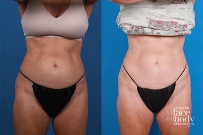 CoolSculpting Before & After Gallery - Patient 816350 - Image 1