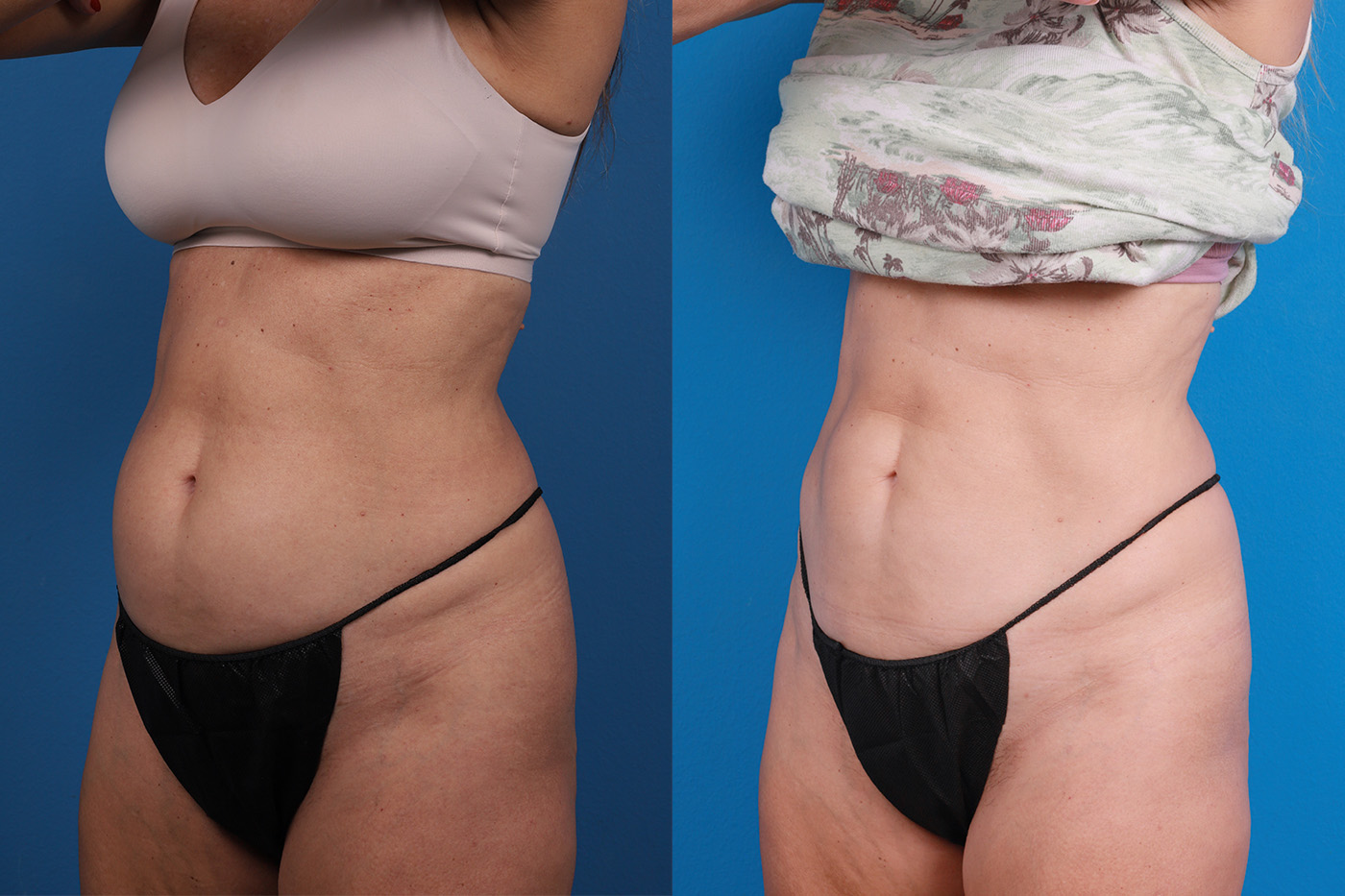 CoolSculpting Before & After Gallery - Patient 816350 - Image 2