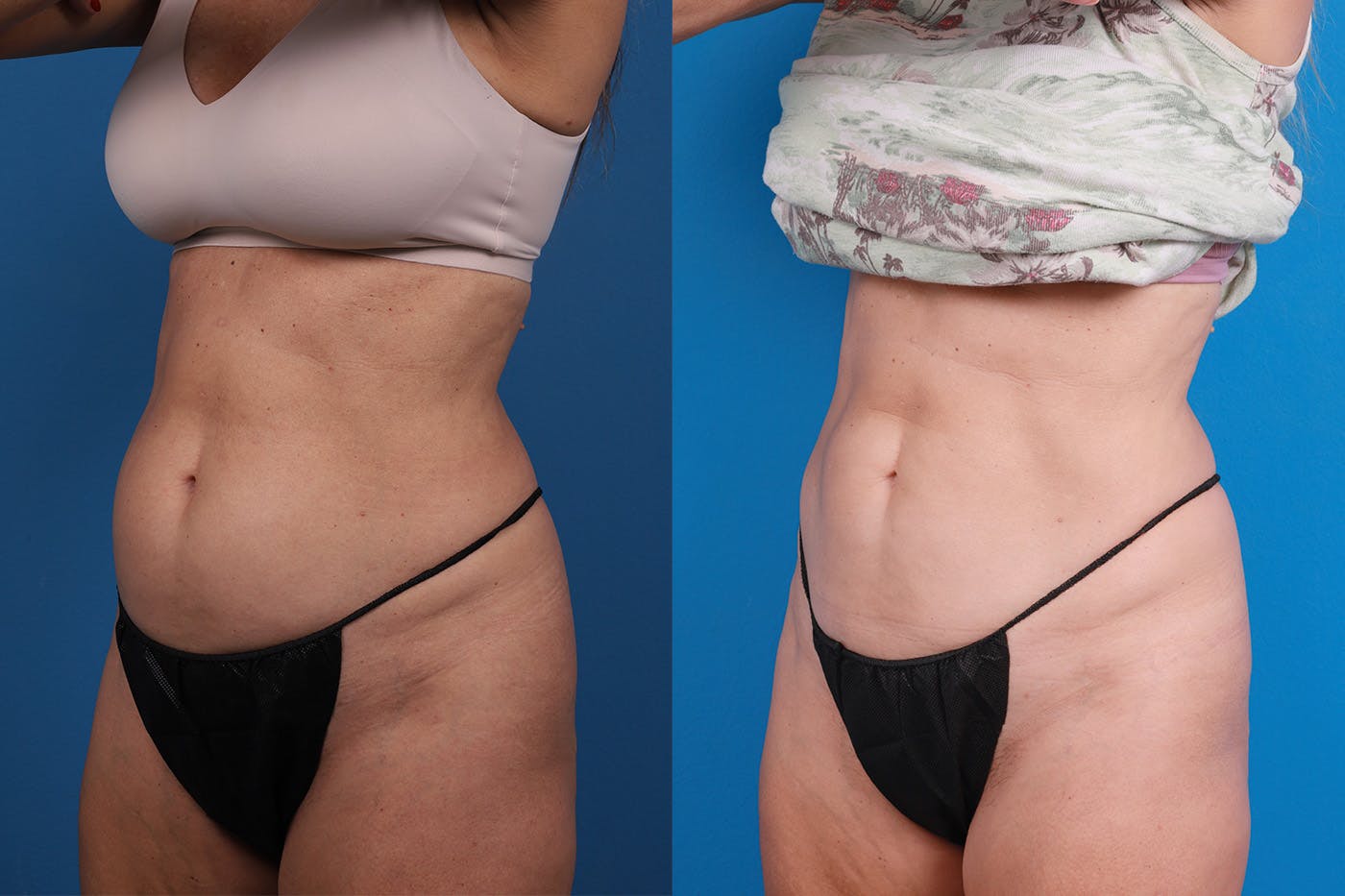 CoolSculpting Before & After Gallery - Patient 148444913 - Image 2