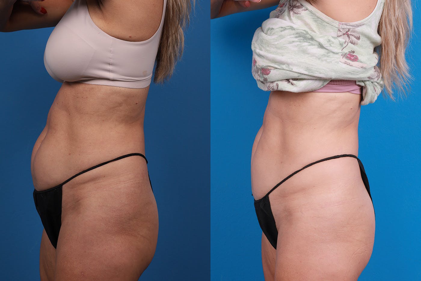 CoolSculpting Before & After Gallery - Patient 148444913 - Image 3