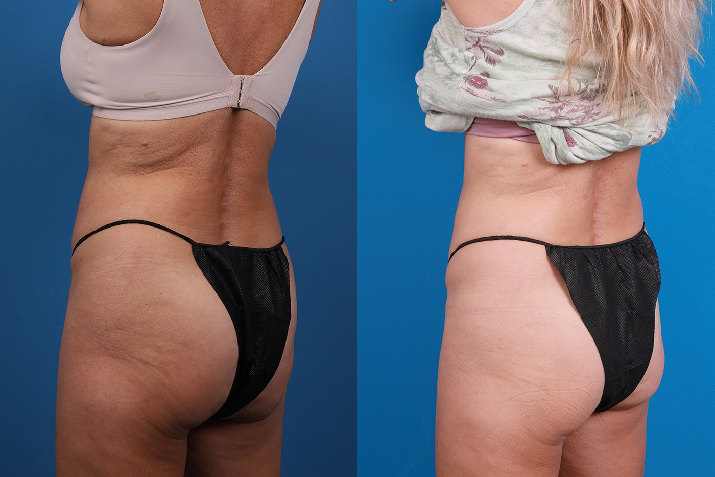 CoolSculpting Before & After Gallery - Patient 816350 - Image 4