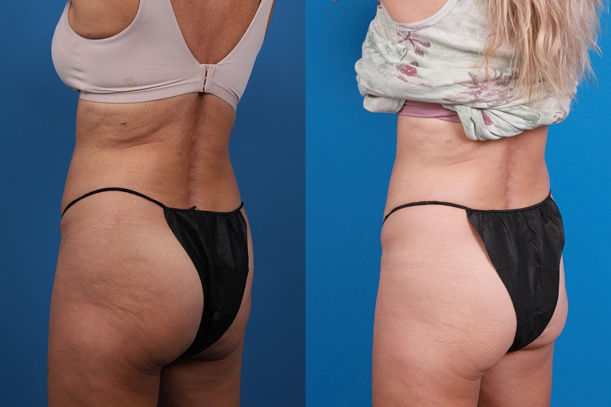 CoolSculpting Before & After Gallery - Patient 148444913 - Image 4