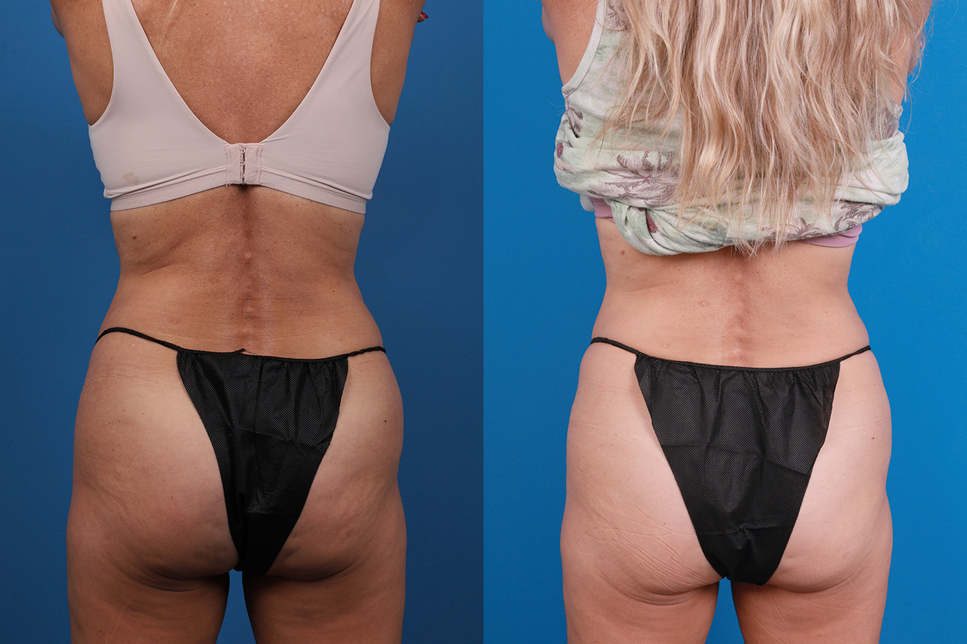 CoolSculpting Before & After Gallery - Patient 816350 - Image 5