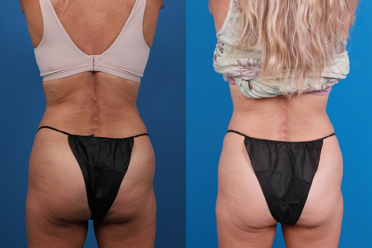 CoolSculpting Before & After Gallery - Patient 148444913 - Image 5