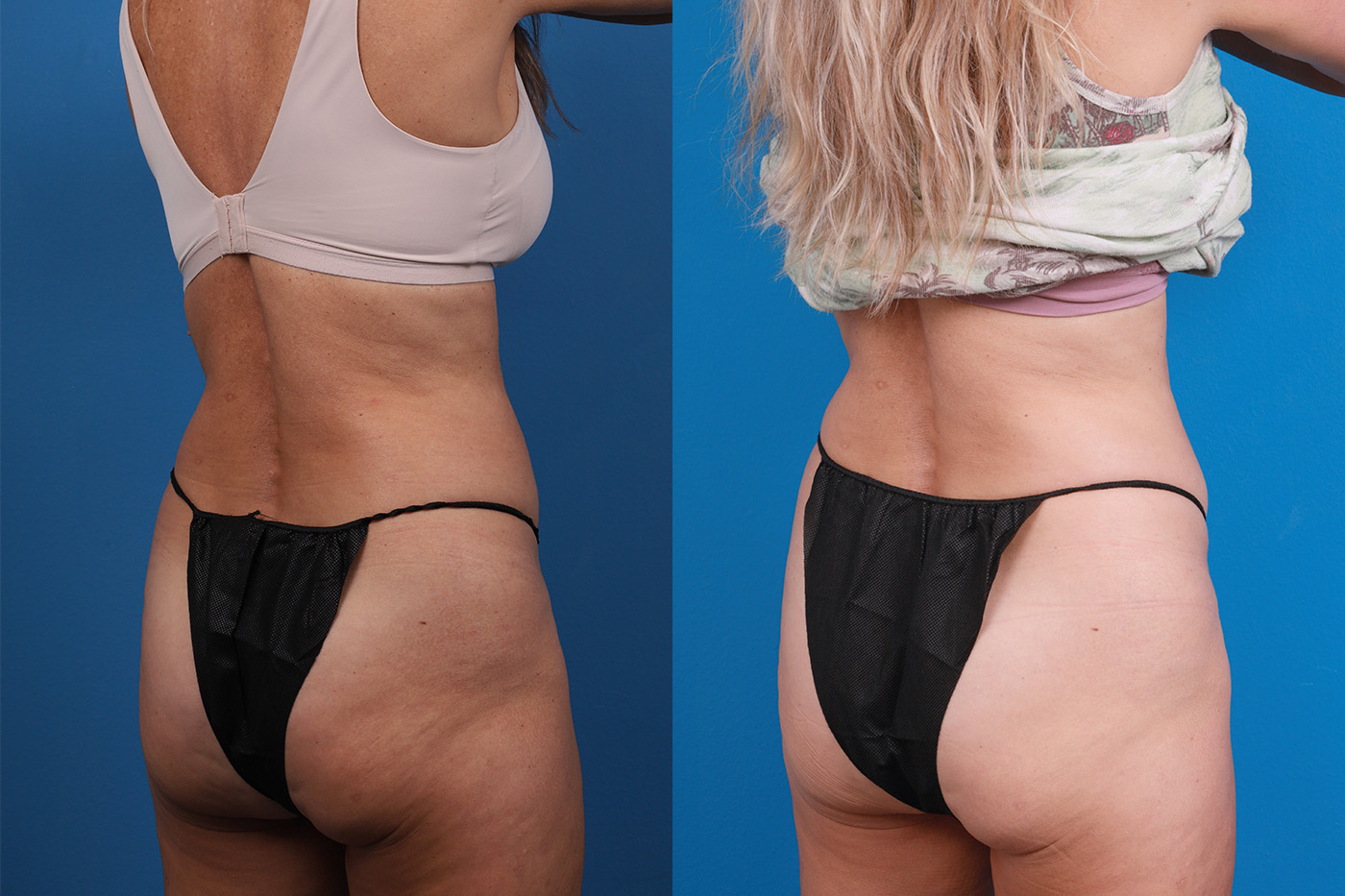 CoolSculpting Before & After Gallery - Patient 816350 - Image 6