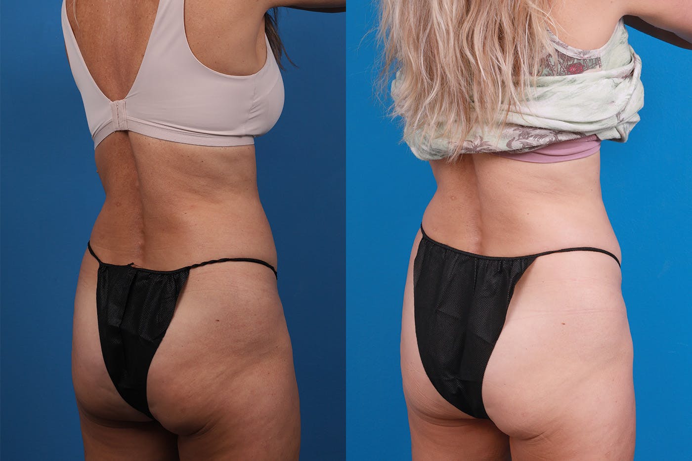 CoolSculpting Before & After Gallery - Patient 148444913 - Image 6