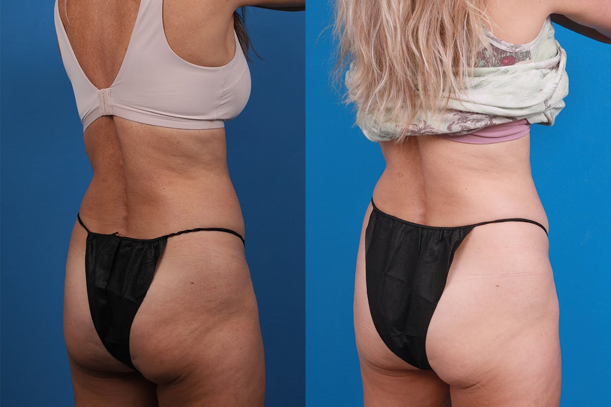 CoolSculpting Before & After Gallery - Patient 148444913 - Image 6