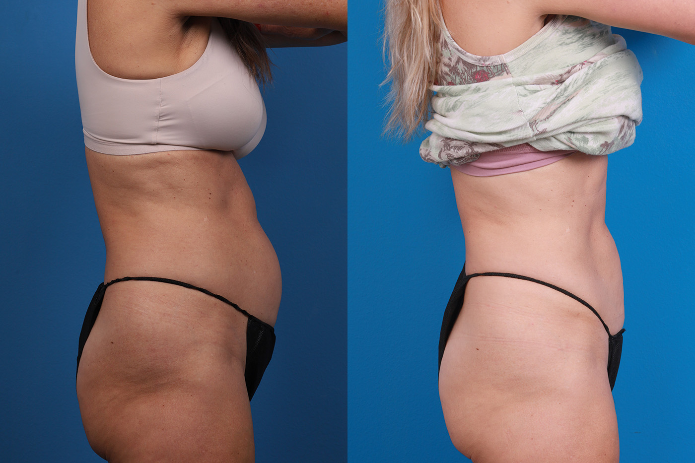 CoolSculpting Before & After Gallery - Patient 816350 - Image 7