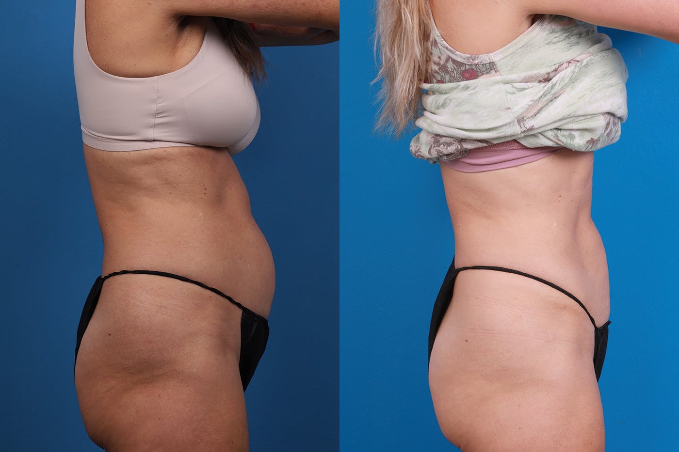 CoolSculpting Before & After Gallery - Patient 148444913 - Image 7