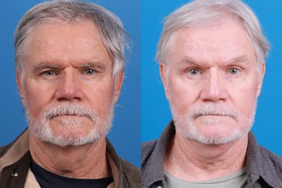 Profile Neck Lift Before & After Gallery - Patient 148444938 - Image 1