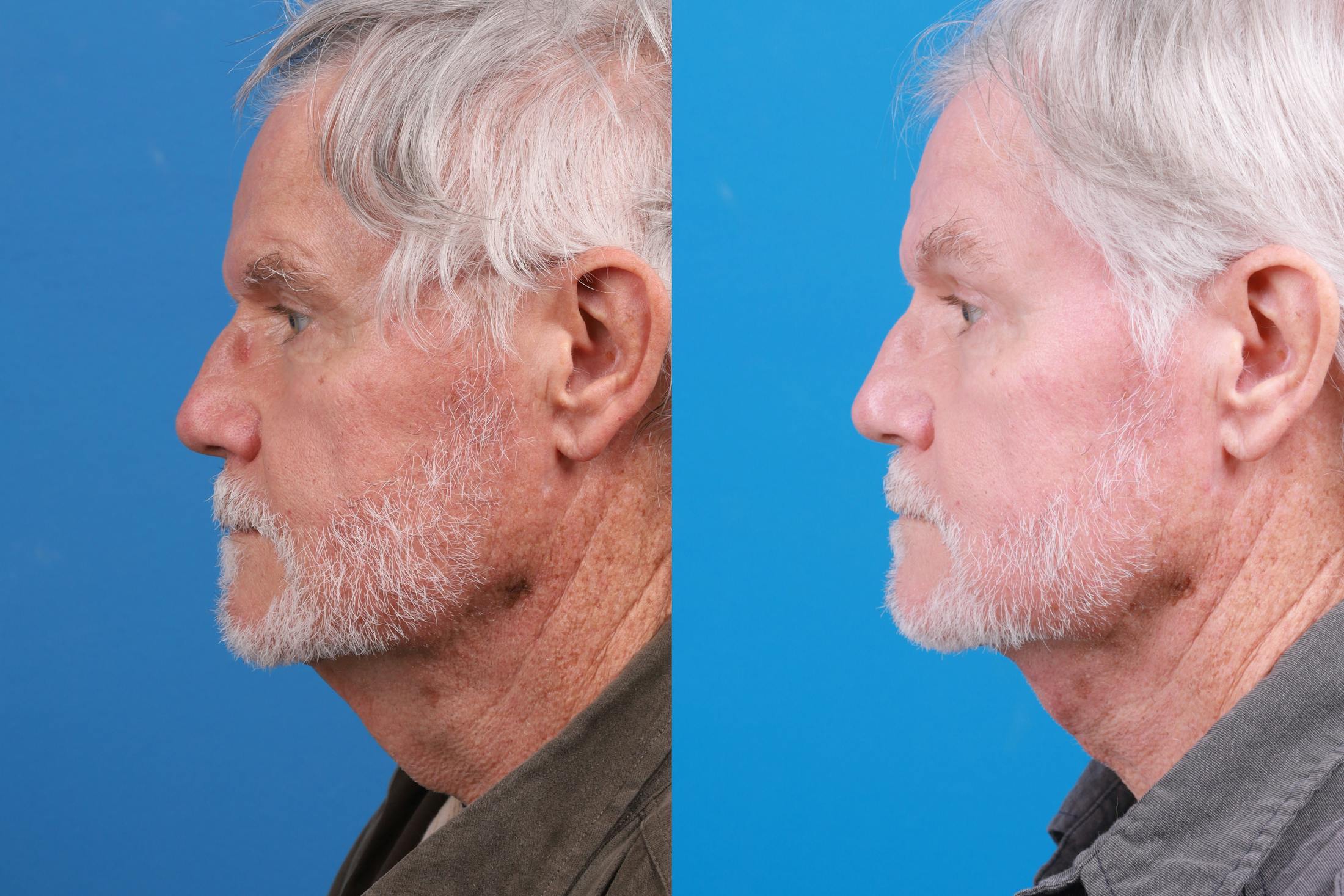 Profile Neck Lift Before & After Gallery - Patient 148444938 - Image 2