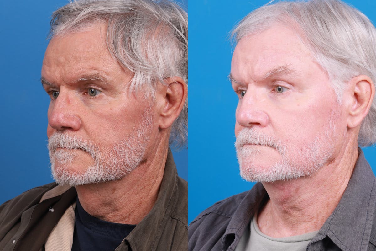 Profile Neck Lift Before & After Gallery - Patient 148444938 - Image 3