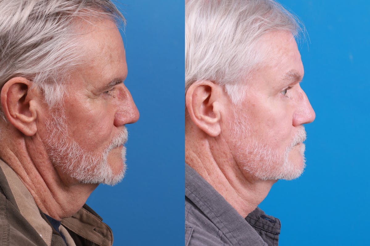 Profile Neck Lift Before & After Gallery - Patient 148444938 - Image 4