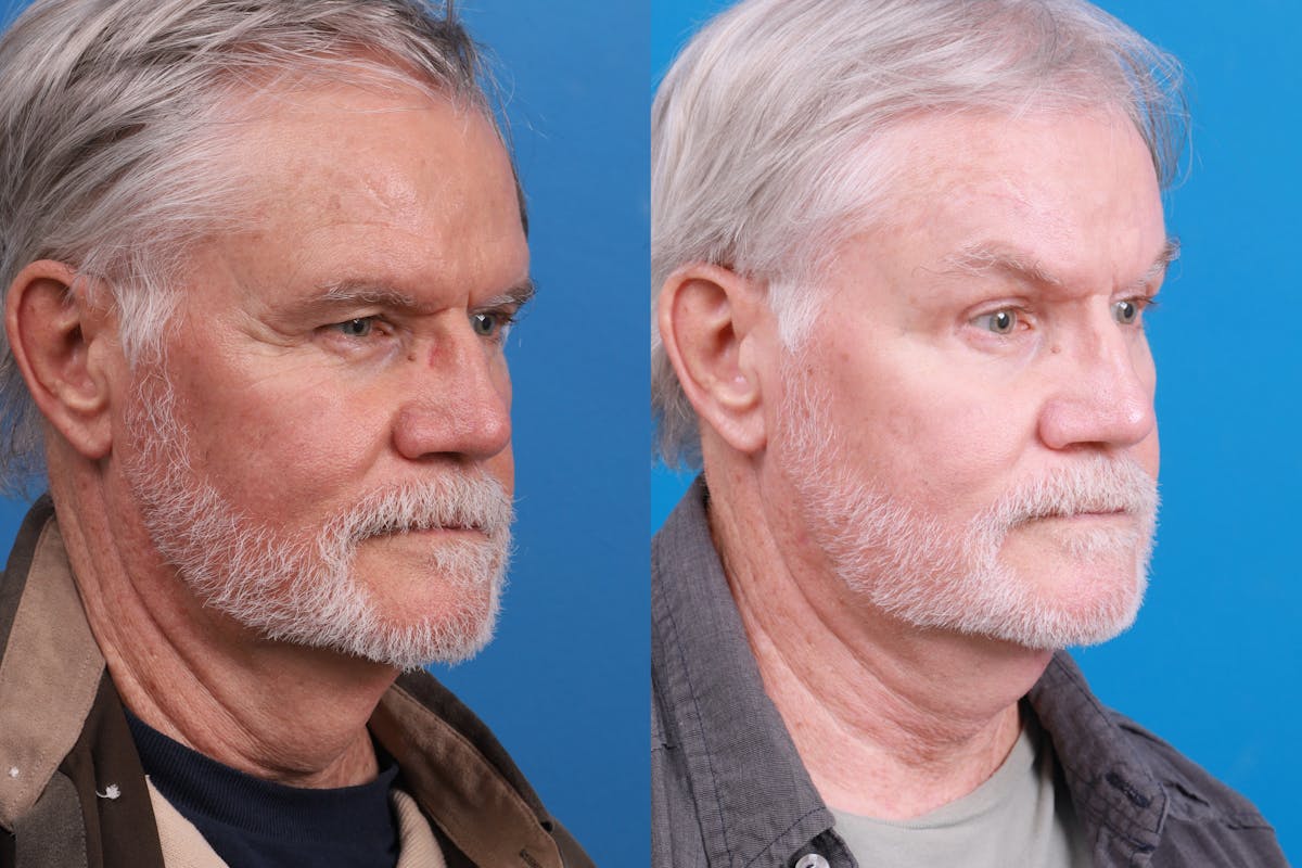 Profile Neck Lift Before & After Gallery - Patient 148444938 - Image 5