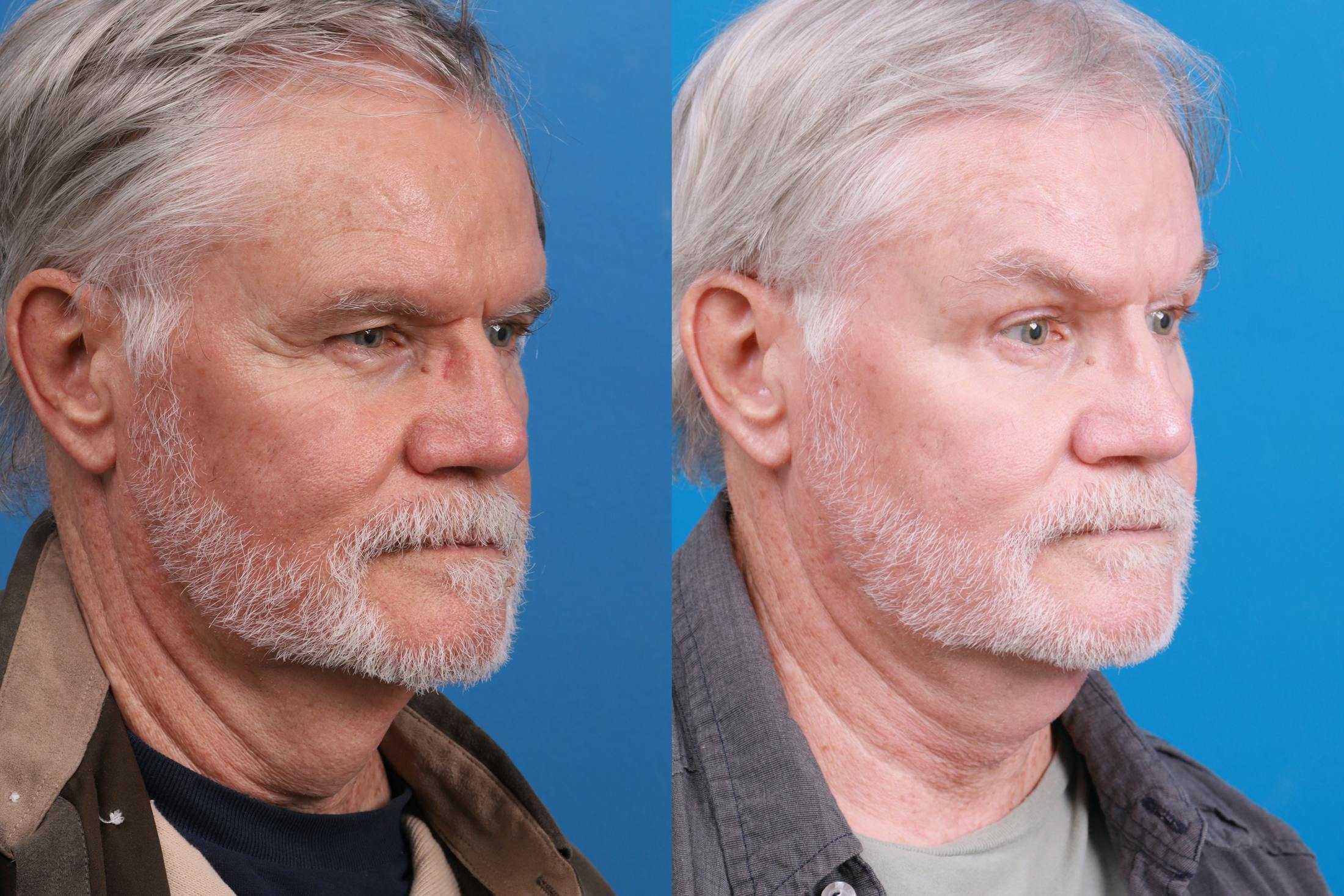 Profile Neck Lift Before & After Gallery - Patient 148444938 - Image 5