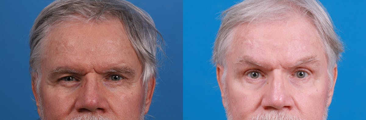 Brow Lift Before & After Gallery - Patient 148444958 - Image 1