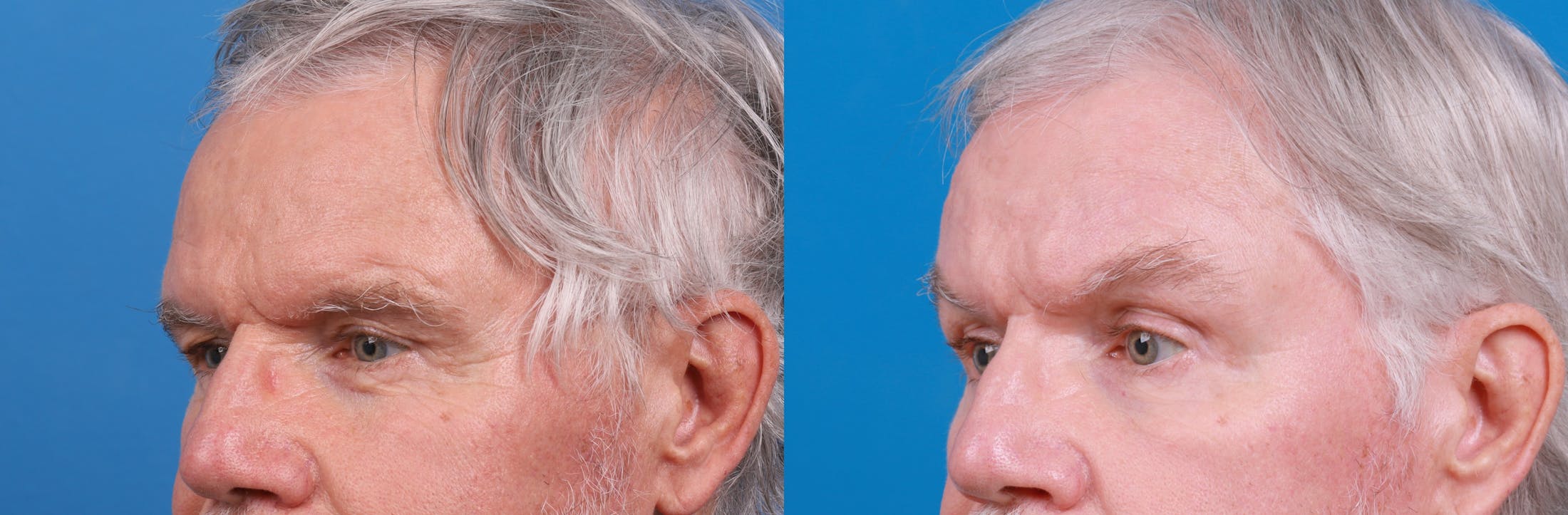 Brow Lift Before & After Gallery - Patient 148444958 - Image 2