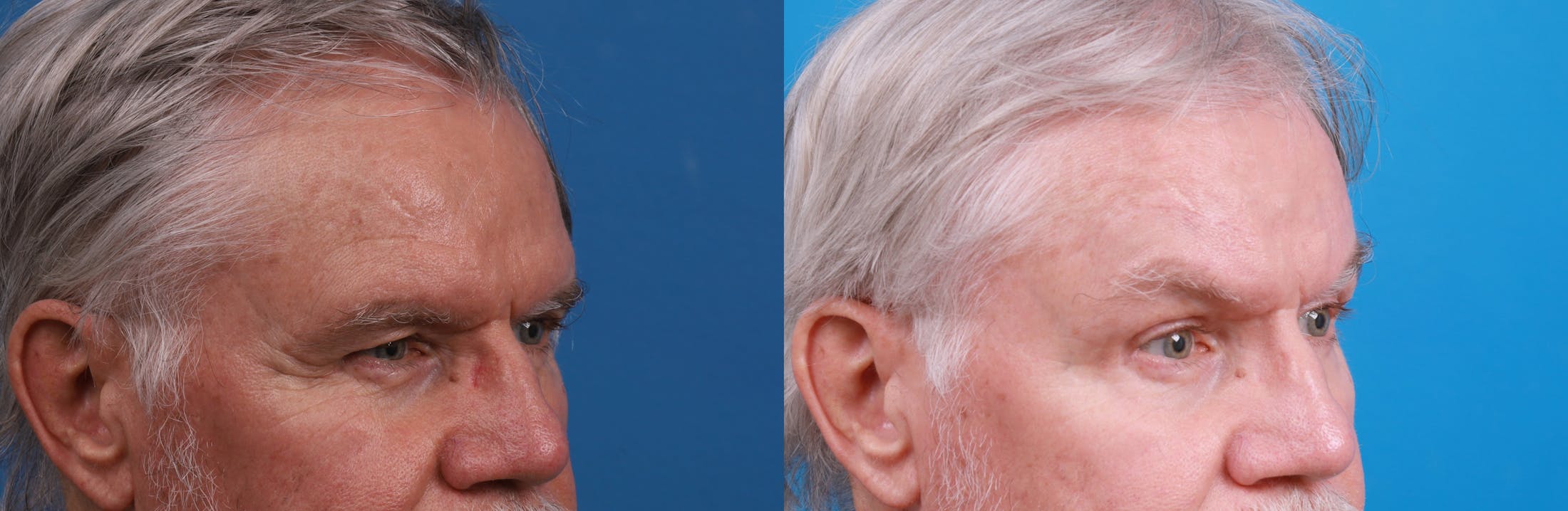 Brow Lift Before & After Gallery - Patient 148444958 - Image 3