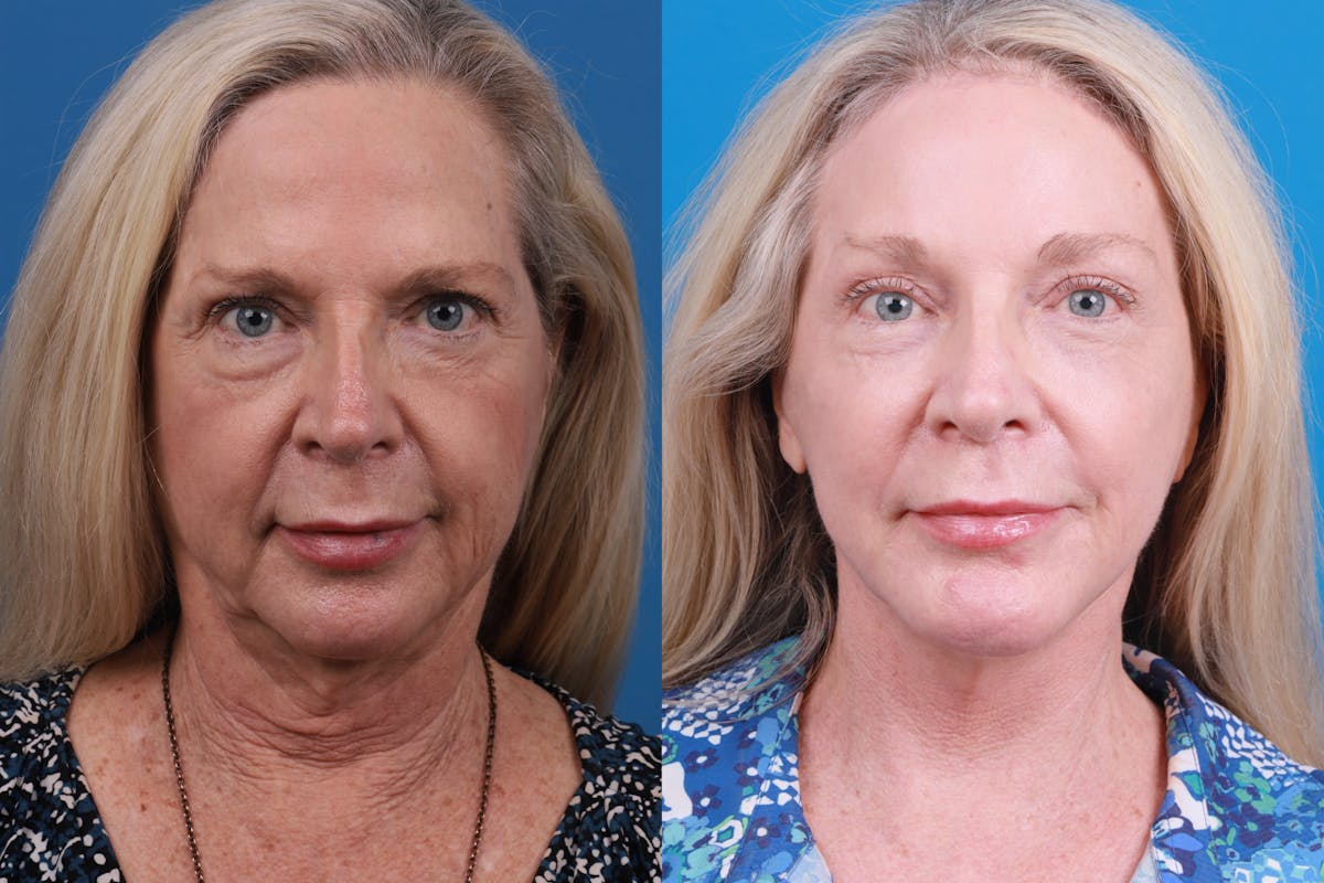 Facelift Before & After Gallery - Patient 148447976 - Image 1