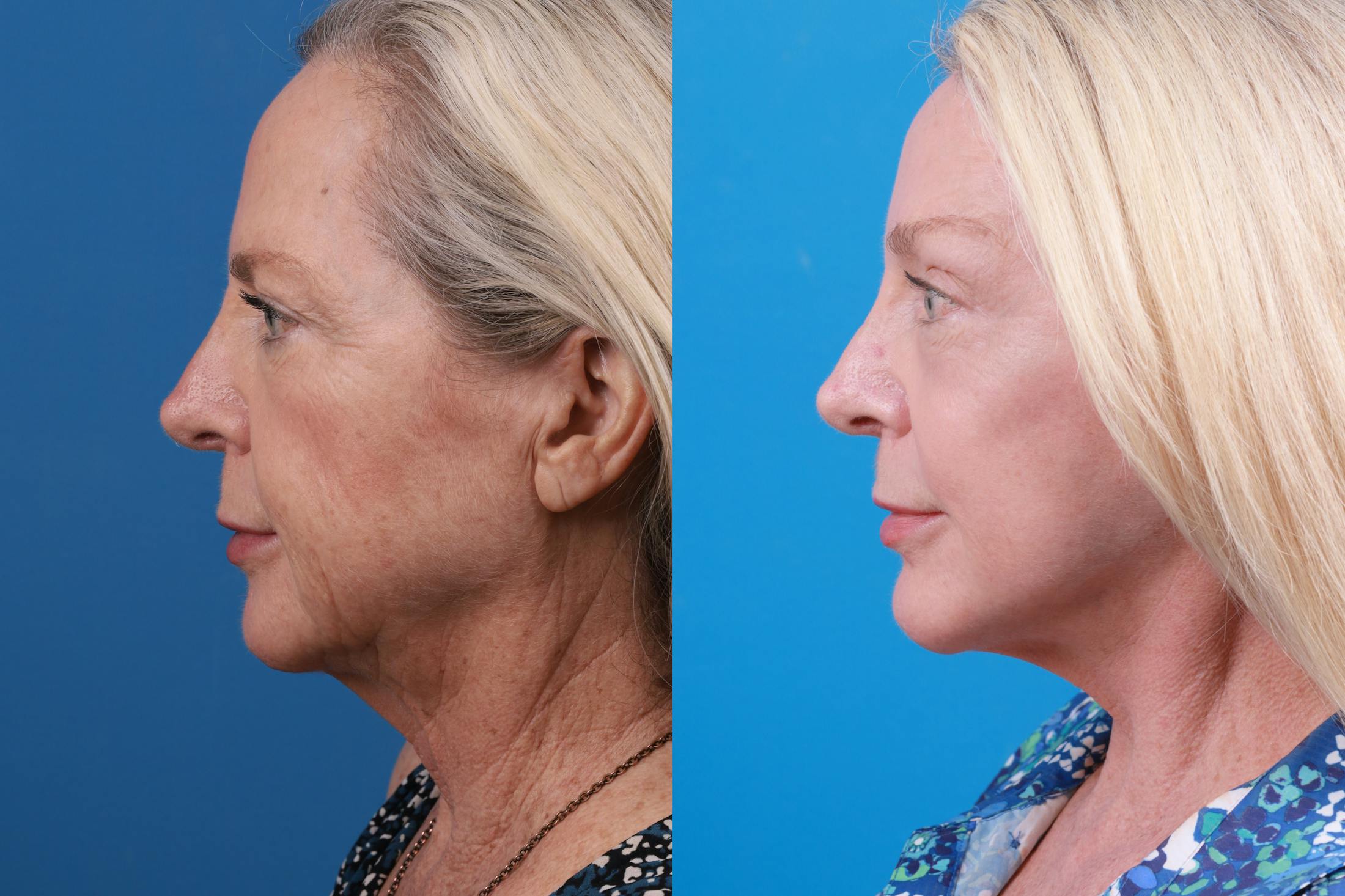 Facelift Before & After Gallery - Patient 148447976 - Image 2