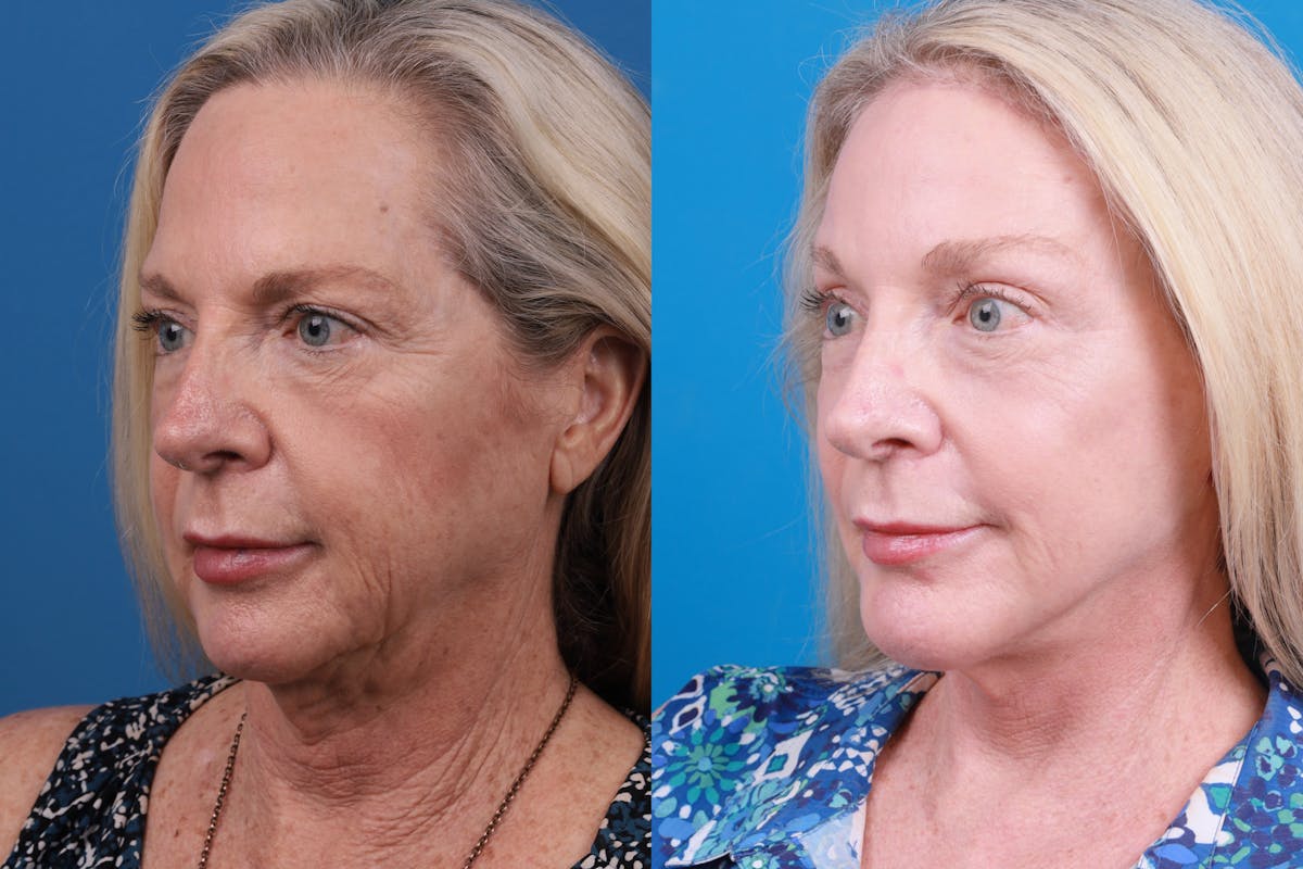 Brow Lift Before & After Gallery - Patient 148447977 - Image 3