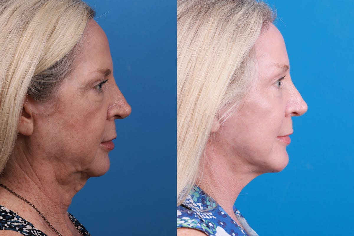 Skin Resurfacing Before & After Gallery - Patient 148445077 - Image 4