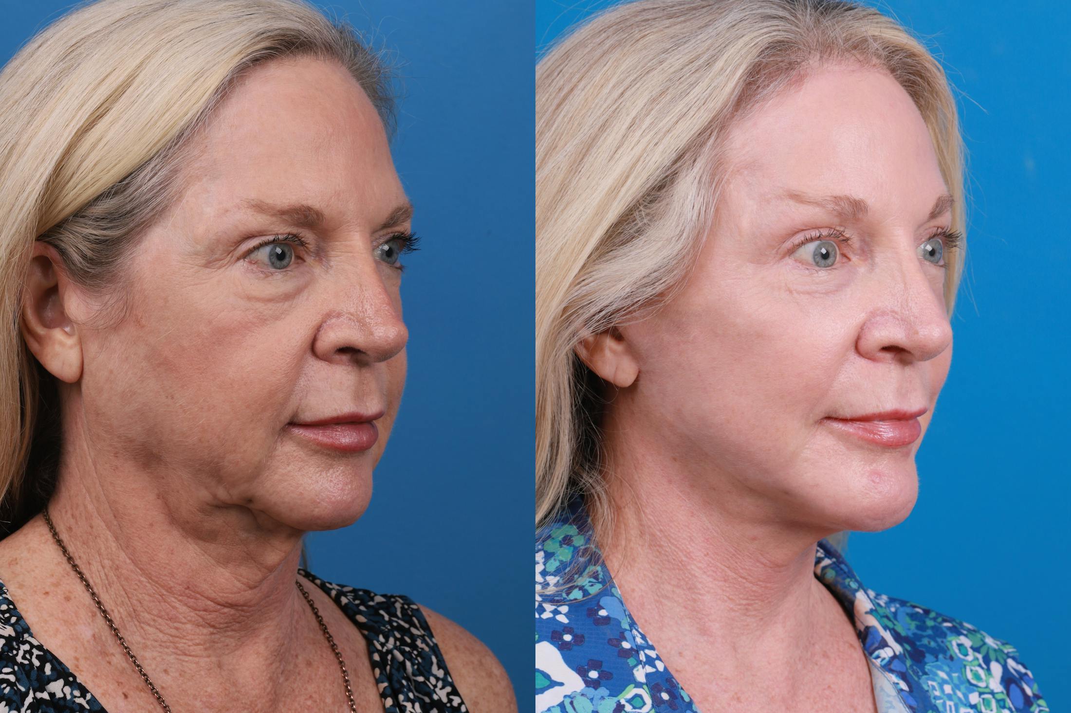 Brow Lift Before & After Gallery - Patient 148447977 - Image 5