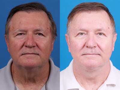 Brow Lift Before & After Gallery - Patient 148036526 - Image 1