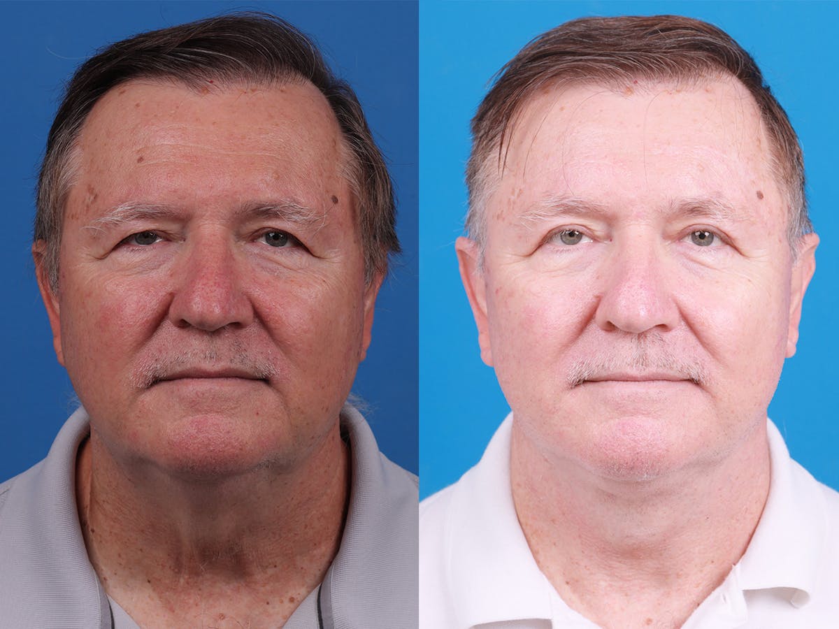 Eyelid Surgery Before & After Gallery - Patient 148036525 - Image 1