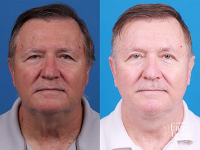 Eyelid Surgery Before & After Gallery - Patient 255142 - Image 1