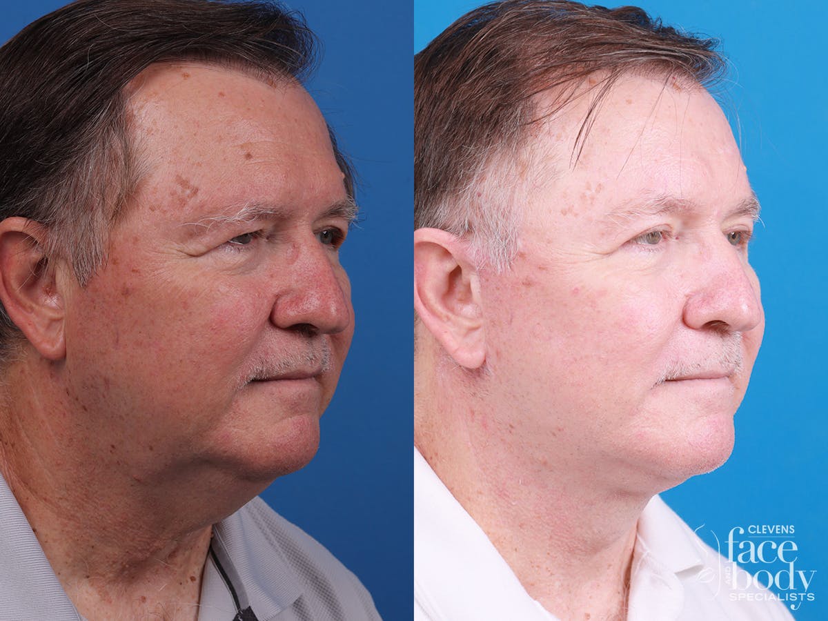 Eyelid Surgery Before & After Gallery - Patient 255142 - Image 2