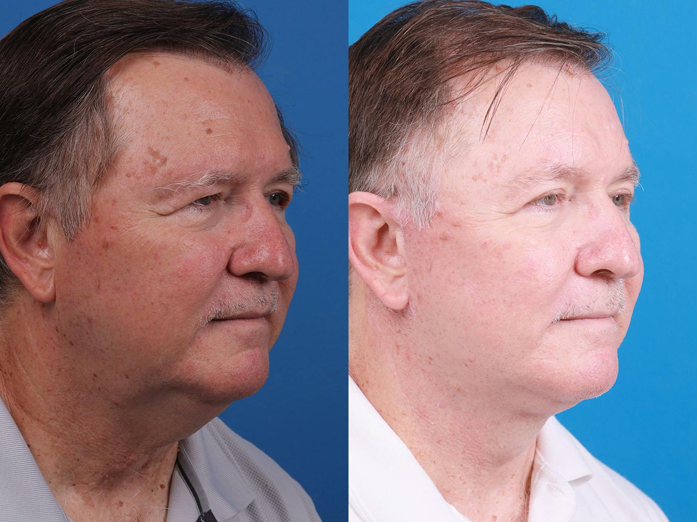 Skin Resurfacing Before & After Gallery - Patient 148447723 - Image 2