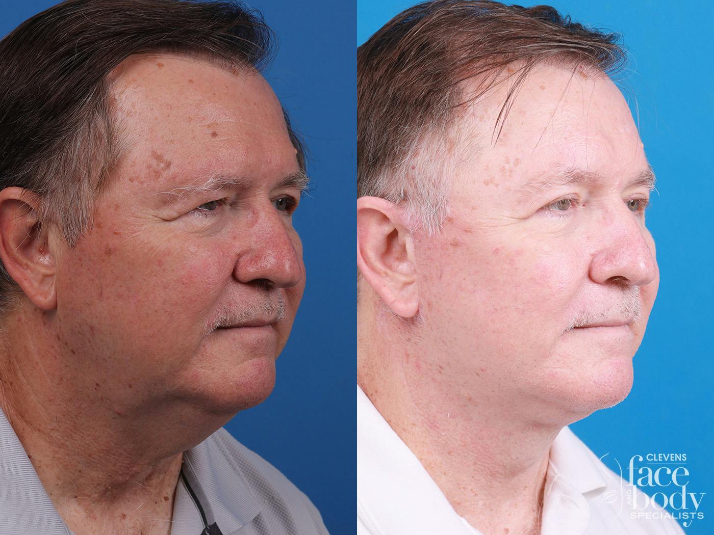 Eyelid Surgery Before & After Gallery - Patient 255142 - Image 2