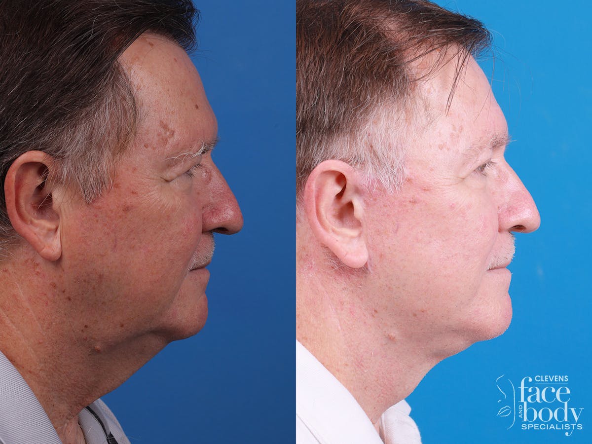 Eyelid Surgery Before & After Gallery - Patient 255142 - Image 3