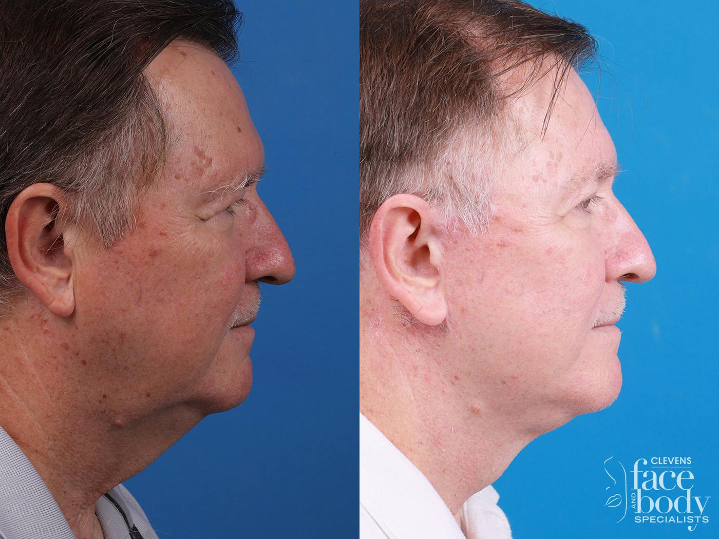 Eyelid Surgery Before & After Gallery - Patient 255142 - Image 3