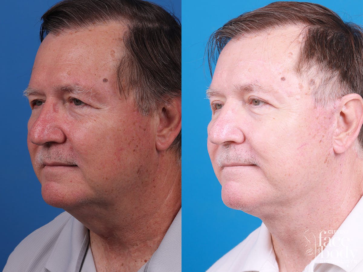 Eyelid Surgery Before & After Gallery - Patient 255142 - Image 4