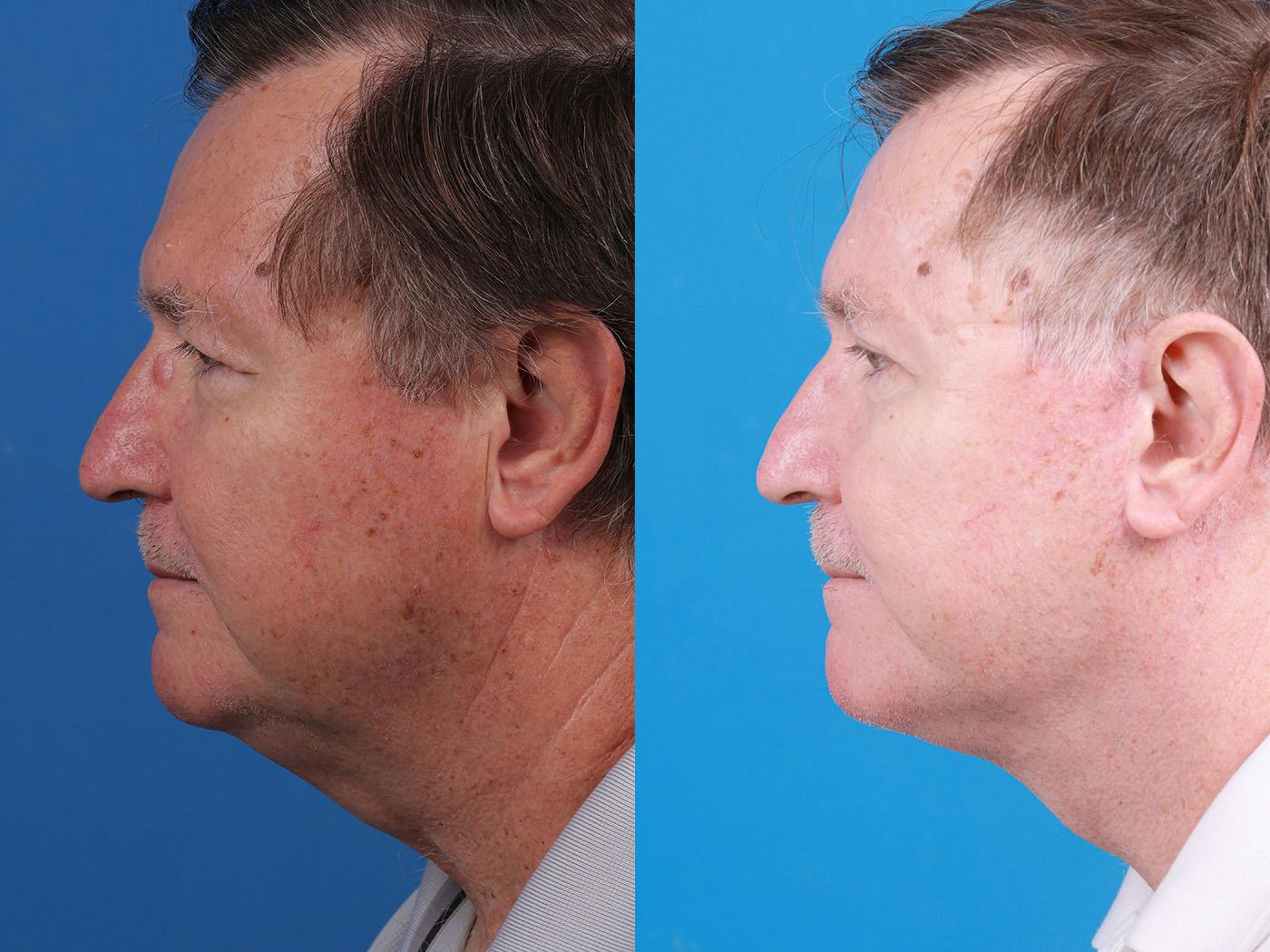 Male Facelift Before & After Gallery - Patient 148036527 - Image 5