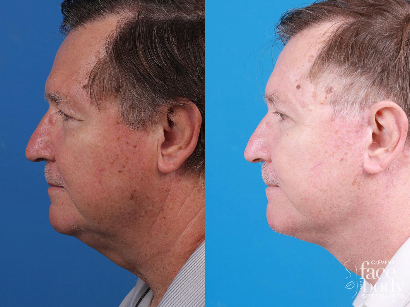 Eyelid Surgery Before & After Gallery - Patient 255142 - Image 5