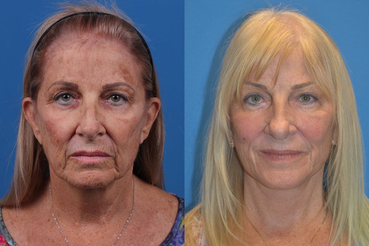 Brow Lift Before & After Gallery - Patient 148466793 - Image 1