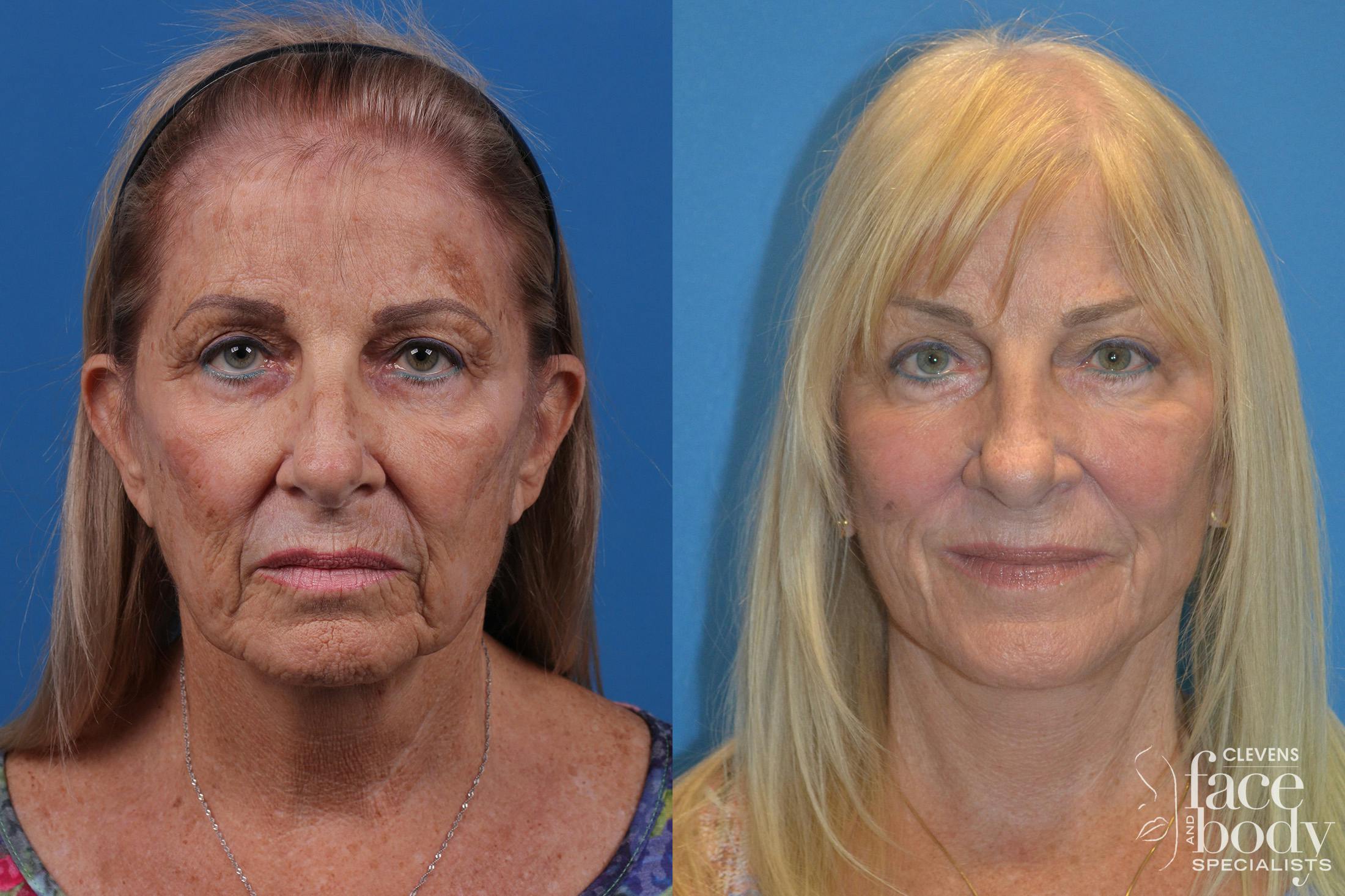 Skin Resurfacing Before & After Gallery - Patient 148466794 - Image 1