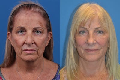Dermal Fillers Before & After Gallery - Patient 148466795 - Image 1
