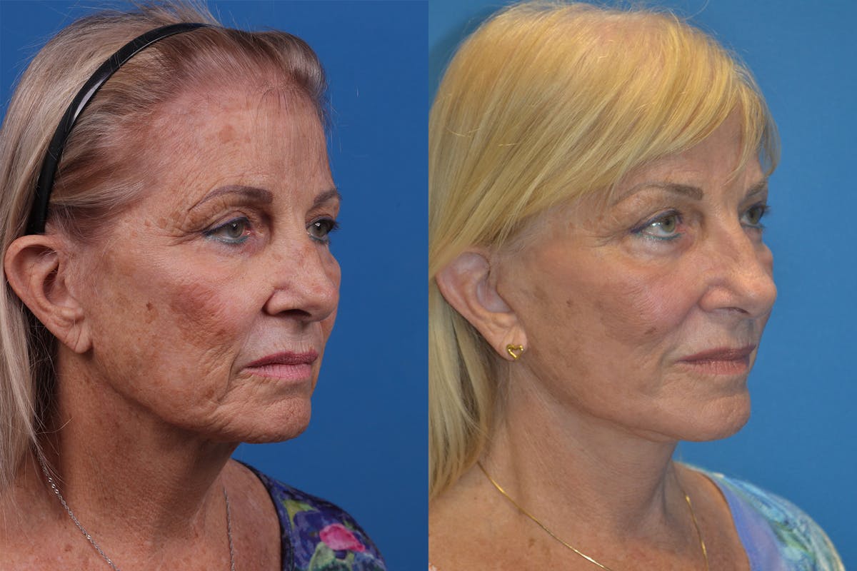 Skin Resurfacing Before & After Gallery - Patient 148466794 - Image 2