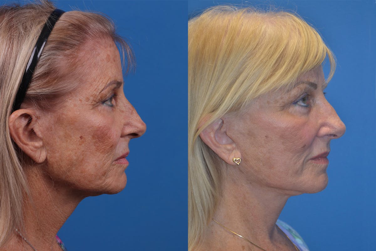 Skin Resurfacing Before & After Gallery - Patient 148466794 - Image 3