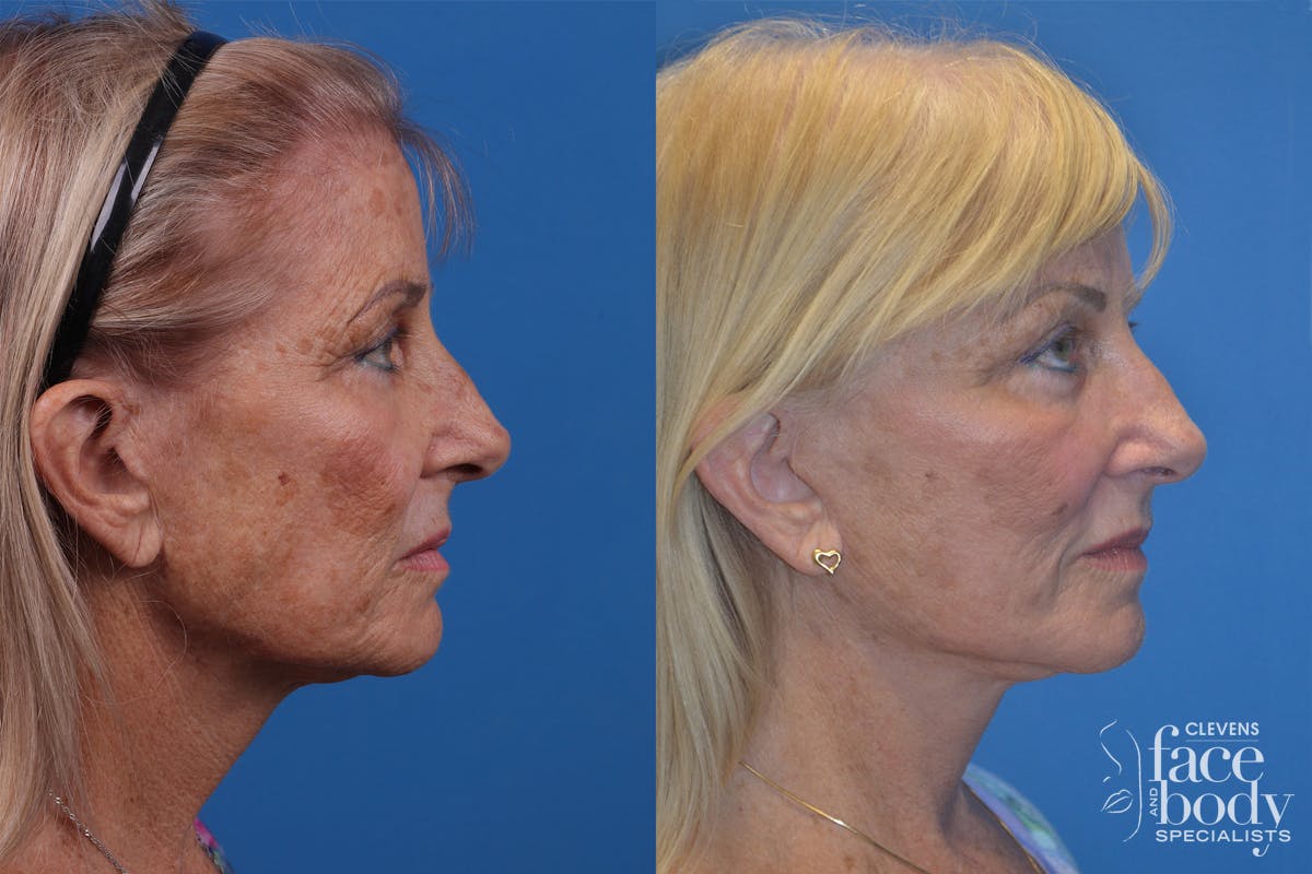 Skin Resurfacing Before & After Gallery - Patient 148466794 - Image 3