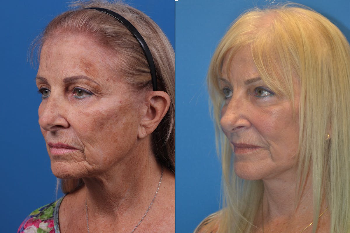 Dermal Fillers Before & After Gallery - Patient 148466795 - Image 4