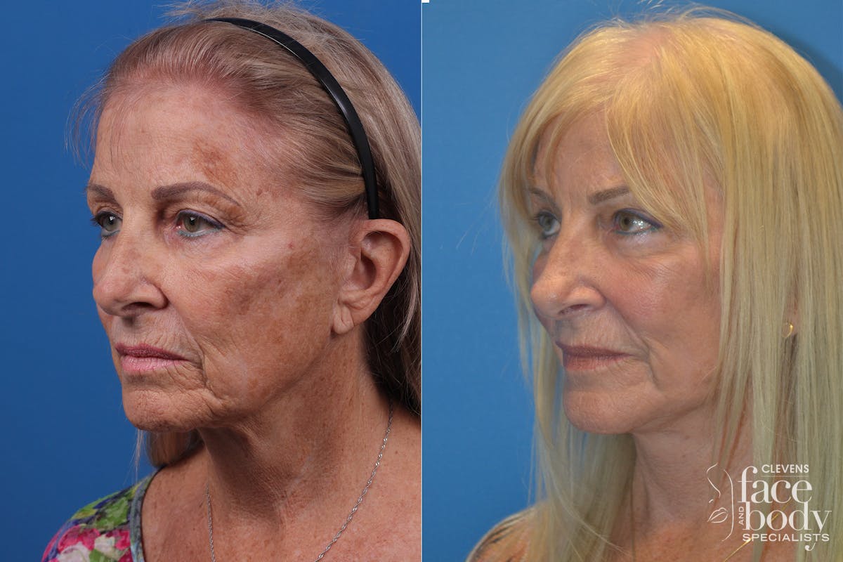 Skin Resurfacing Before & After Gallery - Patient 148466794 - Image 4